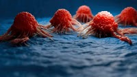 AstraZeneca posts positive data for Imfinzi in bladder cancer (AZN:NASDAQ)