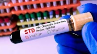 US’s STD epidemic worsened again in 2023