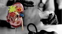 Scientists identify key pathway underlying kidney disease