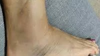 Different Diclofenac diethylamine formulations have similar pain relief and tolerability in acute ankle...