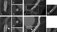 FIGURE 3. Stent extremities evaluation. Panels A (EID-DLCT-XCD) and B...