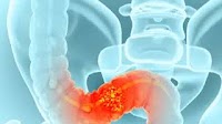 Recent Phase 3 Colorectal Cancer Trials Change Practice