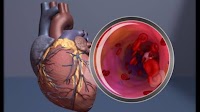 Culture, diet, economic factors and more affect CVD risk among Asian Americans