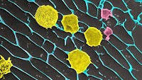 Gel loaded with cancer-fighting cells keeps tumors in check after surgery in mice