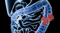 Study Finds New Standard-of-Care for Treatment-Naïve, Aggressive Colorectal Cancer