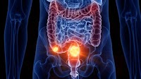 ASCO GI 2025: Practice-Changing Advances in Colorectal Cancer