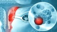 Puxitatug Samrotecan Demonstrates Efficacy, Manageable Safety in Advanced/Metastatic Endometrial Cancer