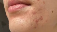 Dermatologist-formulated perfecting gel banishes breakouts and acne scars 'overnight'
