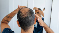 Cure for male pattern baldness given boost by sugar discovery | News
