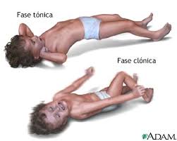 Resultado de imagen para Epilepsia Neonatal