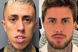 Antes e depois de MC Daniel após procedimentos estéticos viraliza e impressiona fãs