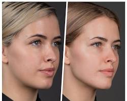 Dermal fillers for cheeks