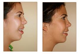 Image result for jaw surgery