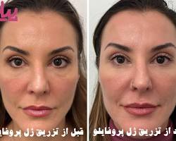 Image of تزریق پروفایلو زیر چشم