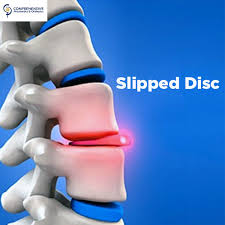 Image result for slipped disc