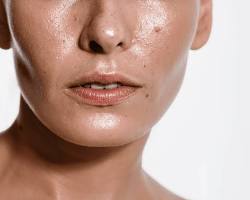Image of Oily Skin