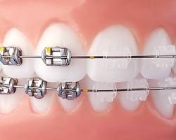 Image of Mắc cài sứ nha khoa