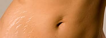 Image result for STRETCH MARK