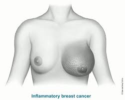 Image result for breast cancer