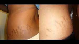 ผลการค้นหารูปภาพสำหรับ mistine lecer anti-stretch mark body cream รีวิว