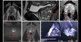 Improving Prostate Cancer Detection: Enhanced Accuracy with MRI Fusion-Targeted and Systematic Biopsy - 1
