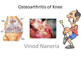 osteoarthritis-treatment-knee-back-lower-pain-psoriatic-severe-california-downey-7028.jpg via Relatably.com