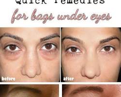 Gambar Potato for eye bags