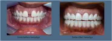 Image result for invisalign images before after