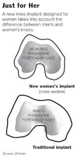 Women Get Knees to Call Their Own - New York Times - 20060511_KNEE_190x383