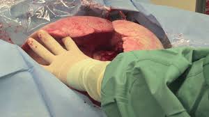 Image result for images of human organ for transplant