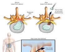 Imagem de Discectomia