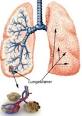 Fakta om lungebetennelse - Nettdoktor