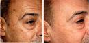 Age Spots on Face - Age Spot Removal