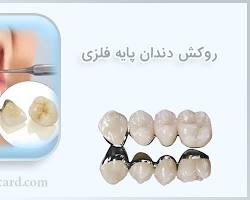 روکش دندان فلزی