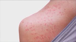 Measles Cases Reported in Texas: What You Need to Know