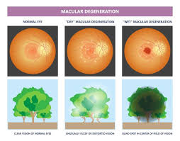 Powerful Nutrients That Safeguard Your Vision Against Macular Degeneration - 1