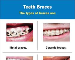 Image of Different Types of Braces