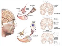 Cara mengobati Alzheimer