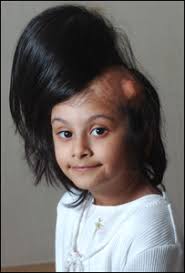 Sidra Afzal before the surgery. It is now hoped Sidra will return to school in September - _43043359_sidraside203300