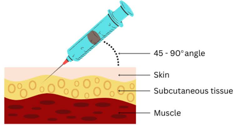 Giving Subcutaneous Injections - Gateshead Health