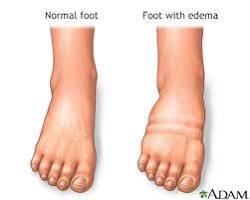 Swollen ankles and feet due to prolonged sitting or standing