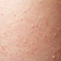 Skin condition keratosis pilaris treatment uk