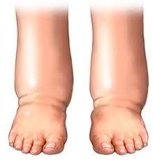 фото отечных ног 1