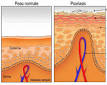 Psoriasis - Quelle alimentation? - PasseportSant.net