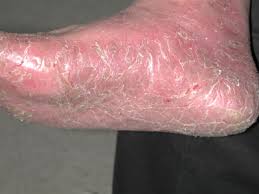 Image result for PSORIASIS