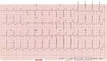 Wolff-Parkinson-White Syndrome (WPW) Cleveland Clinic