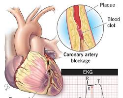 Image of STEMI Heart Attack