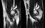 Lacertus fibrosus mri Sydney