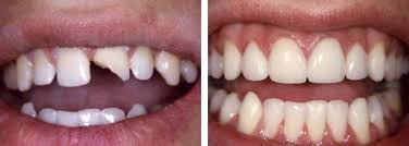 Kết quả hình ảnh cho trước - sau bọc răng sứ