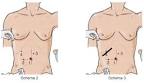 Ablation de la vsicule : quels risques? Actualit - Sant